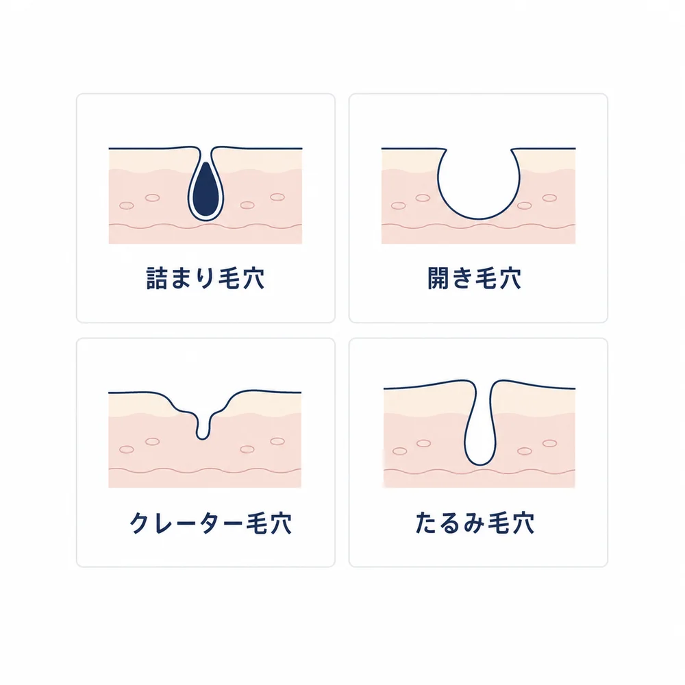 毛穴の4タイプ(詰まり毛穴・開き毛穴・クレーター毛穴・たるみ毛穴)の違いを示す図解